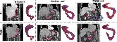 Leveraging deep learning-based segmentation and contours-driven deformable registration for dose accumulation in abdominal structures